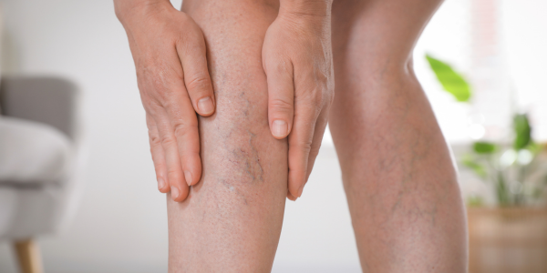 Vein Health